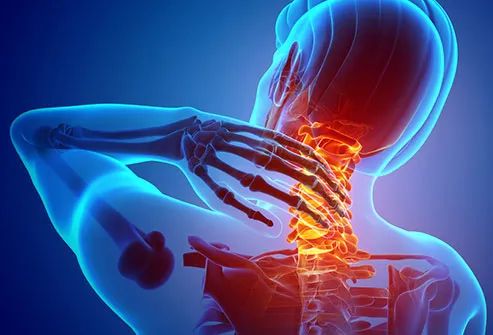 Cervical Spondylosis