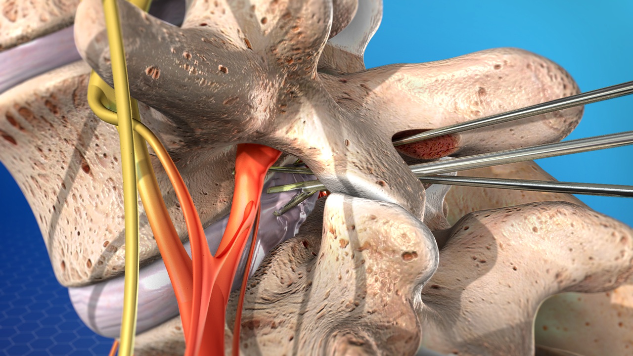 Micro Discectomy