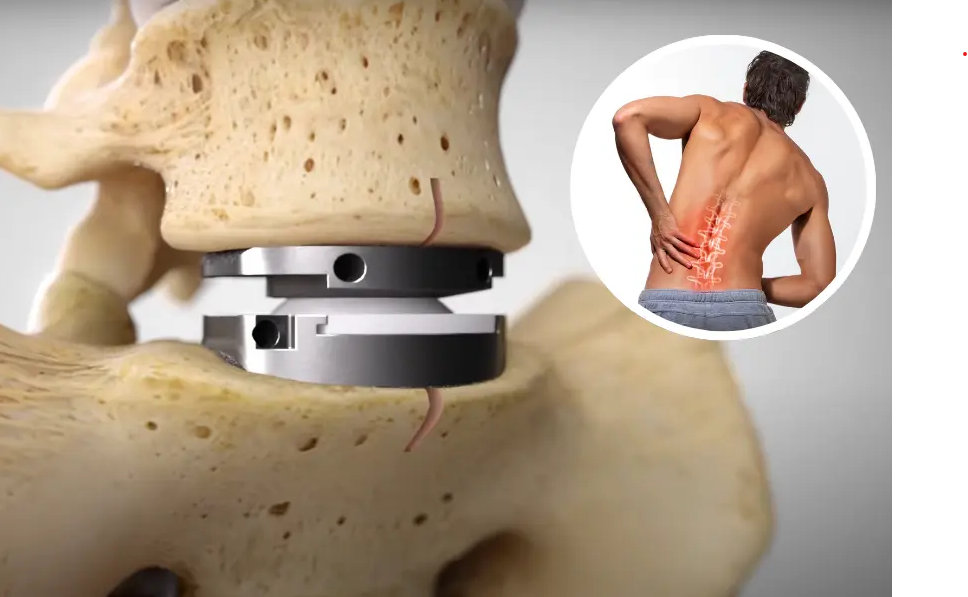 Disc Replacement Surgery