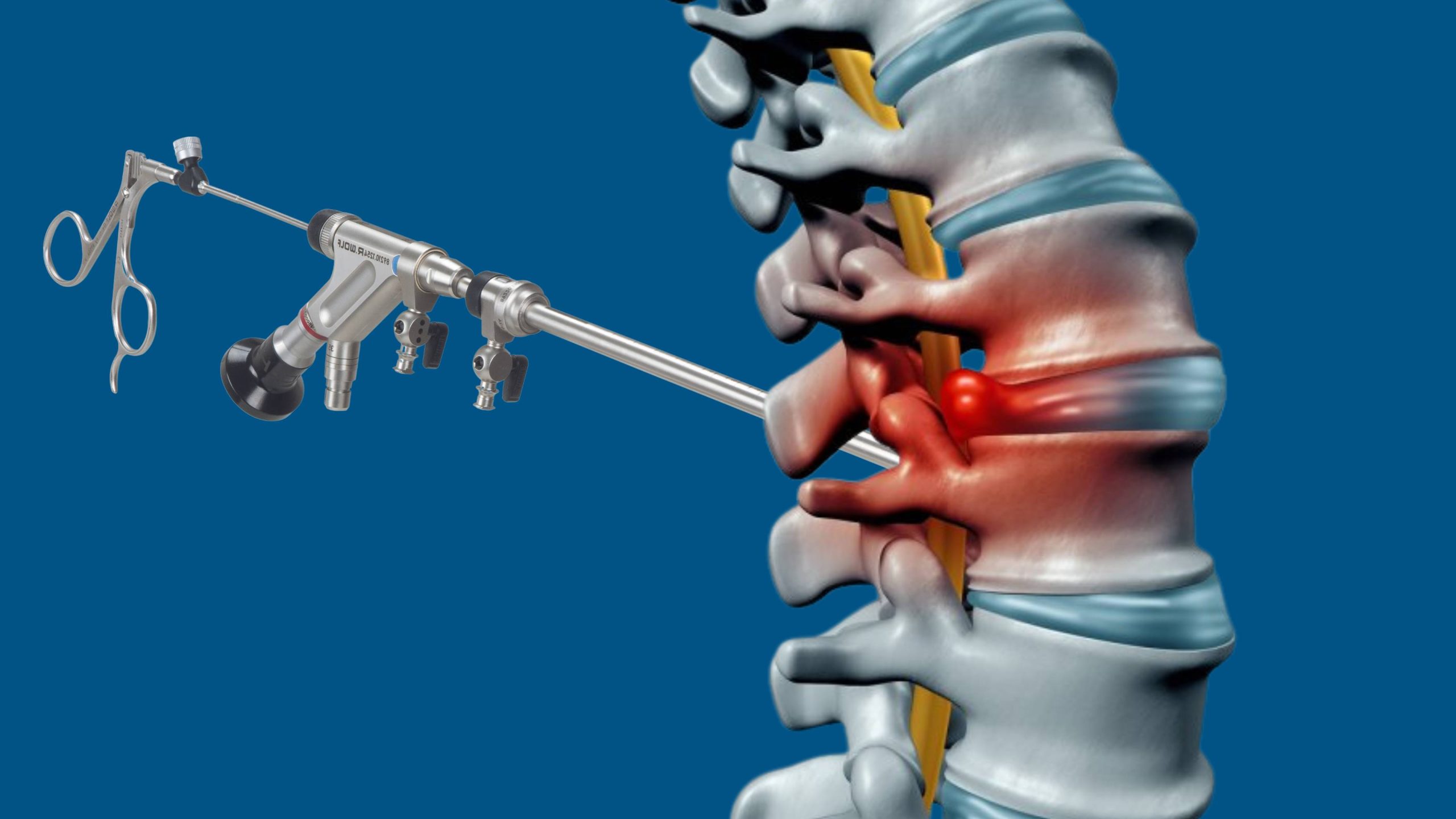 Endoscopic Discectomy