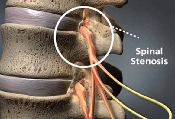Foraminal Stenosis
