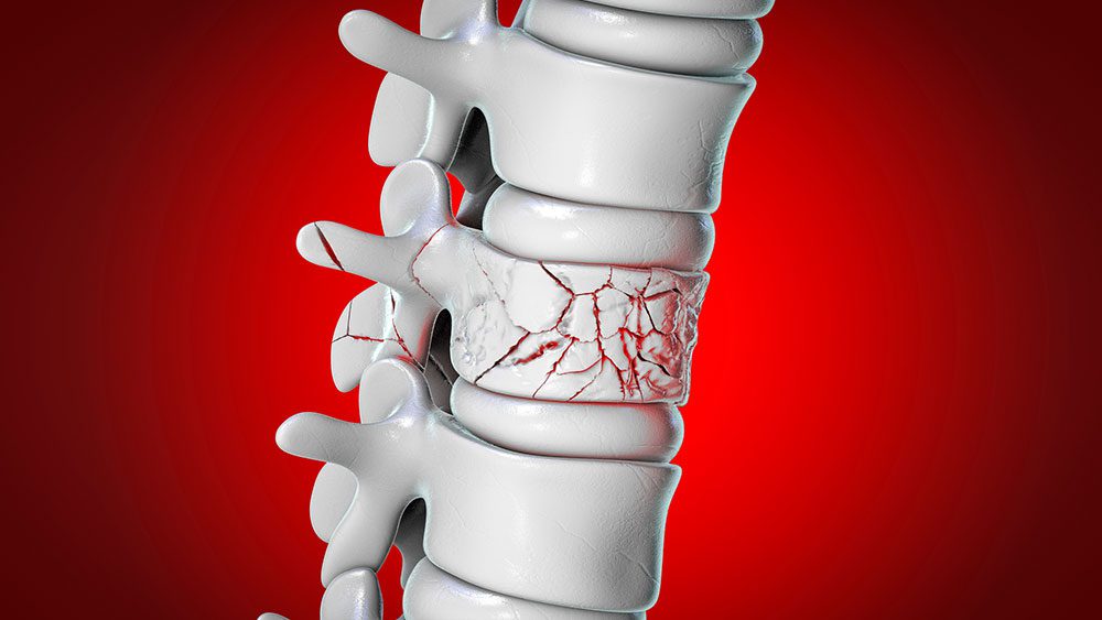 Vertebroplasty